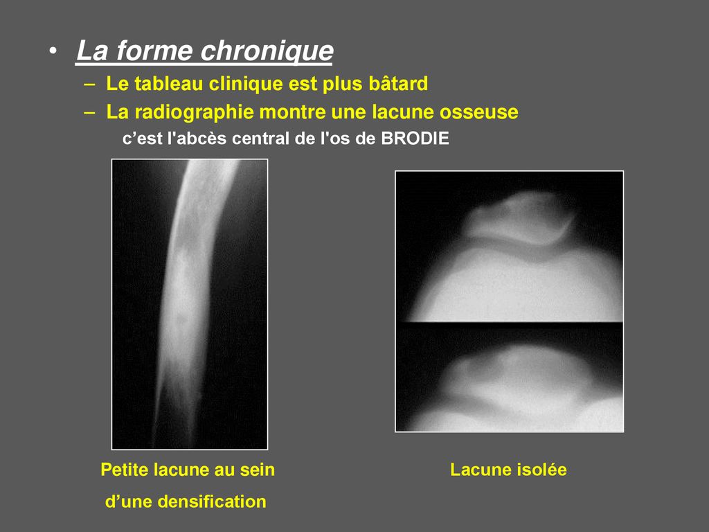 Les infections ost o articulaires ppt t l charger